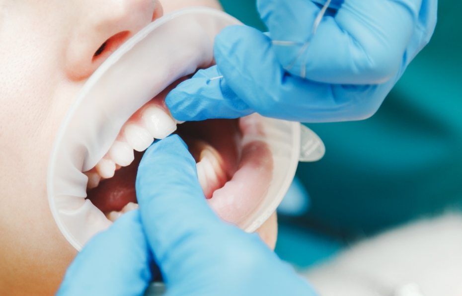 close-up-of-female-mouth-with-retractor-doctor-PWRQ6FA(1)